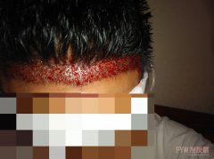 本人在科发源植发失败2次的惨遭，还被吭骗,科发源黑心