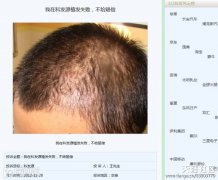 众多发友在科发源植发失败，我和小伙伴都惊呆了！