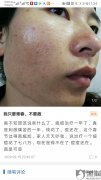 痘博士虚假宣传，误导消费，钱花了不少，脸却不好