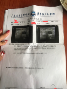 乳腺纤维瘤广东省人民医院乳腺科主任太黑心