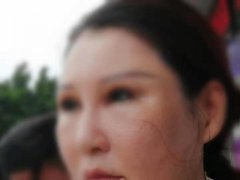 六年间她在惠州鹏爱医疗美容医院做医疗美容花费44万余元 现在脸部出现严重肿胀