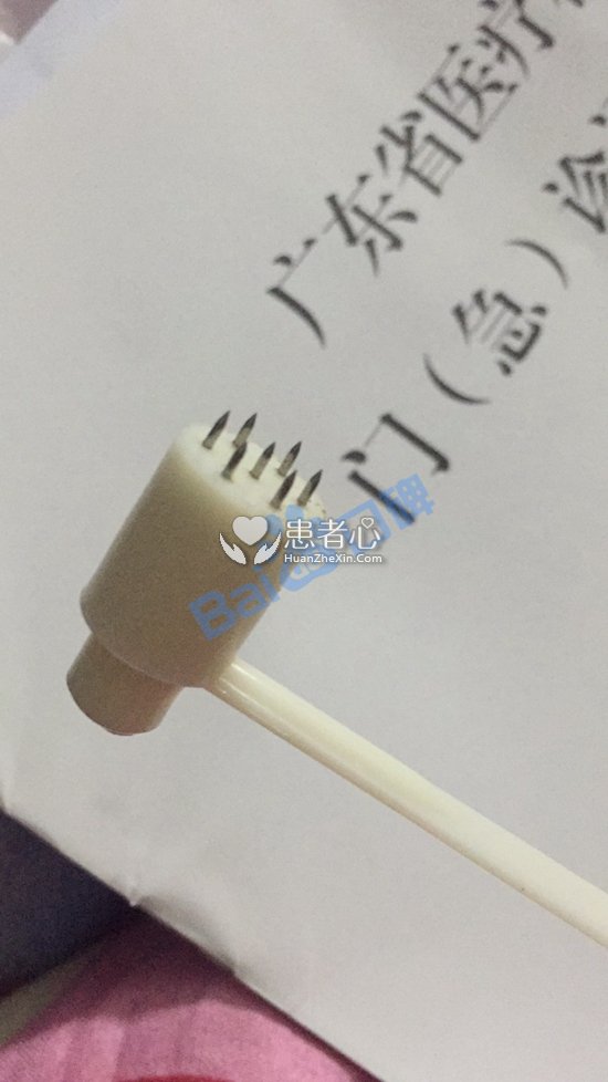 深圳新兴皮肤病专科门诊治脱发 梅花针扎头皮一疗程一千多