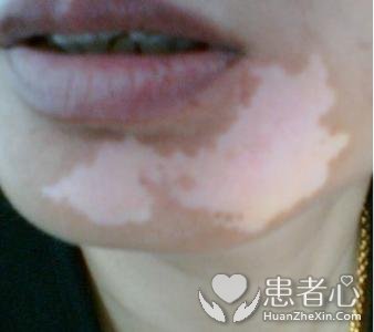 东莞肤康医院太黑白癜风没有消除反倒增多了