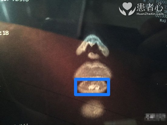 合肥博士整形医院打玻尿酸把我毁容 事后还威胁我