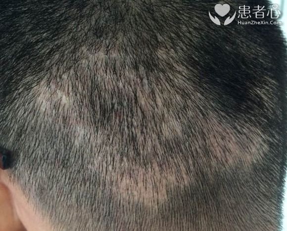 我要曝光南京新生植发医院欺诈坑骗