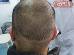 曝光南京新生植发医院根本治不好脱发只会骗钱千万别上当