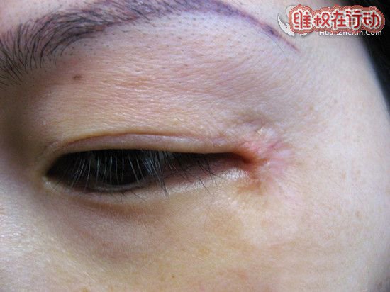 苏州爱思特整形美容医院整容变毁容 妙龄女整成疤痕眼