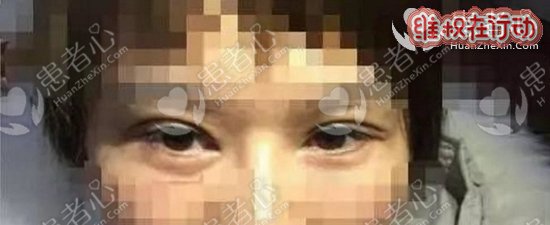 南京维多利亚整形美容医院给我带来了面部毁容