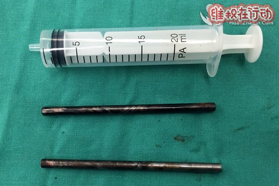成功救治一名两根十厘米铁钉刺入头部患者