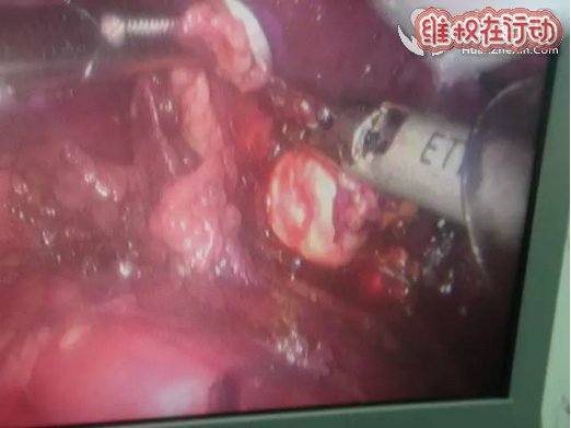 3D腹腔镜助力南华泌尿外科肾上腺手术