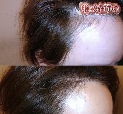 郑州无资质微整形工作室(塑颜美业)给我带来的头顶困扰