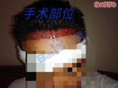 广州科发源植发的两次失败经历，存活率是零（多图揭露）