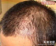 315曝光科发源植发失败小护士植发 主任打一针就走(转载)