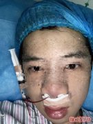 美莱医院怎么样？长沙男子花2.3万在美莱医院隆鼻失败