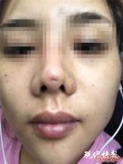 Jur整形骗局：南京怡华医疗美容医院整形失败 隆鼻后成了“猪鼻子”