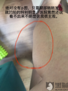 医佑美怎么样？医佑美诊所医生注射失误致使腿部凹陷