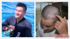 长沙安曼达整形医院维权事件！局麻还是全麻？男的也这么爱美！