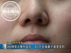 南昌方大整形医院6万整鼻感觉被坑了！同时也被360搜索给害了！