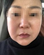 江北尚丽整形美容医院整形怎么样？真相：2万整形 脸却歪了！