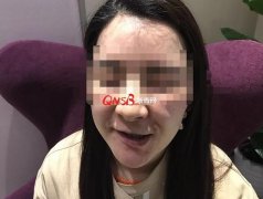 杭州美莱整形医院蒋铮铮院长那里近40万整容 居然中毒了！