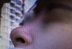 温州克拉美整形医院怎么样？隆鼻整形出问题怪先天条件不好！！