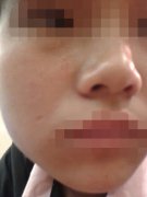 湖南中医药研究院附属医院骗子祛疤无效 疤痕变“肉坑”_001投诉无数