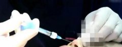 南宁韩成医疗整形美容医院整形达不到预期 鼻子有点歪！