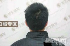 ╚南京新生植发医院╗⑥Gou∈坑爹~-坑骗死人不偿命
