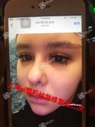 上海AL国际整形医院把我鼻子做毁了_用我照片打广告骗人！垃圾AL