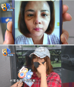 杭州华山连天美整形医院又遭到投诉了 一女子称鼻部整形后鼓包现象!