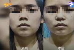 杭州甄美整形医院把人鼻子整歪了？医院：自己长歪了！