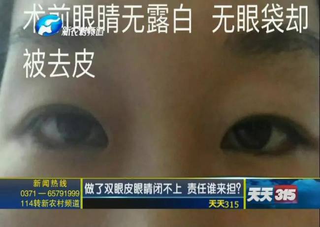 整形美容有风险 做了双眼皮眼睛闭不上 责任谁来担?
