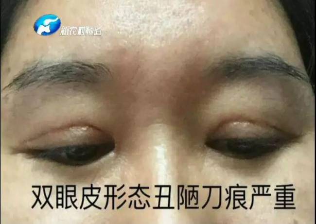 整形美容有风险 做了双眼皮眼睛闭不上 责任谁来担?