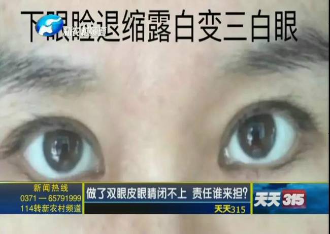 整形美容有风险 做了双眼皮眼睛闭不上 责任谁来担?