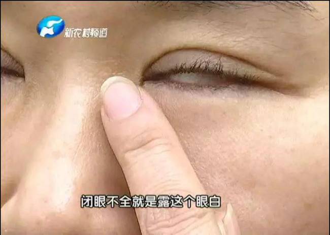 整形美容有风险 做了双眼皮眼睛闭不上 责任谁来担?