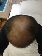我在科发源植发两年多失败了，机构还到处封帖
