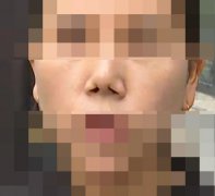 【曝光】赫尔本整形程明医生，把我的鼻子整失败了