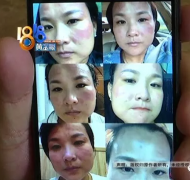 密思芬美容怎么样？本想“逆时光” 结果密思芬美容后脸红得像关公不敢见人了！