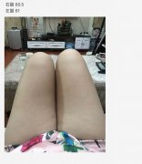 南昌亚太医疗美容医院抽脂手术后情况很糟糕 女子维权却被骂出来