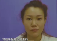 杭州格莱美整形医院把美女鼻子成了S型 只敢开美颜拍照