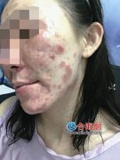 漳州翌芙莱美容店涉嫌无证经营 打“水光针”致女子脸部溃烂变形