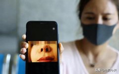 28岁女子在安徽佳禾医疗美容6万做美容整形 4个月后鼻孔一大一小怎么办？