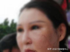 在惠州鹏爱医疗美容医院做医疗美容，累计花费44万余元
