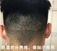 盘点植发容易踩的4个大坑！绝大多数人不知道的内幕！建议想植发的都看看!