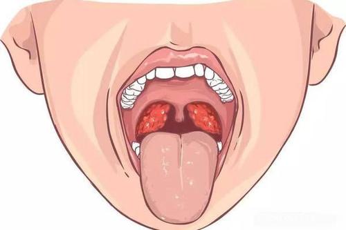 扁桃体发炎吃什么食物好