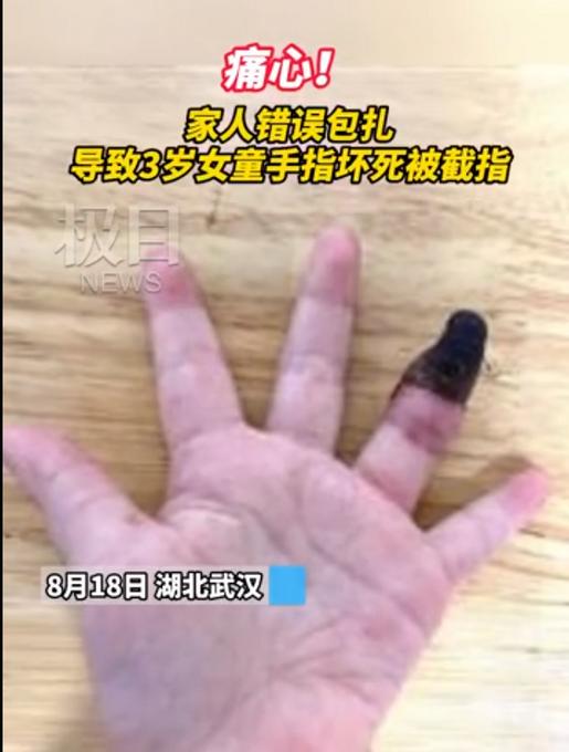 创可贴别乱用!家人错误包扎致3岁女童手指坏死,网友:心疼