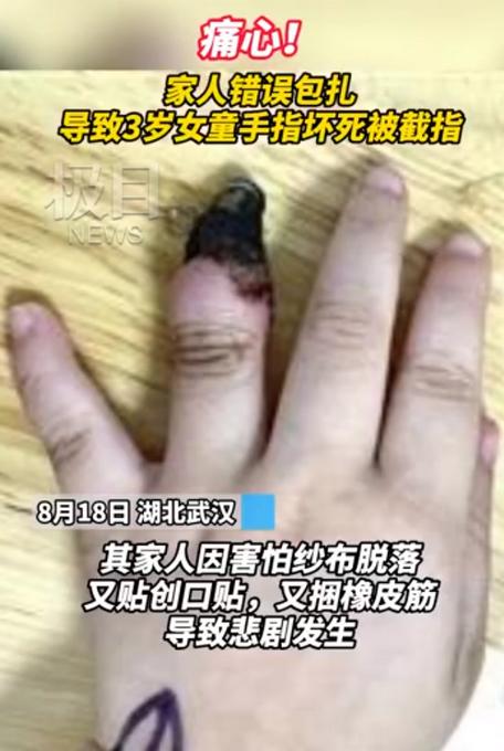 创可贴别乱用!家人错误包扎致3岁女童手指坏死,网友:心疼