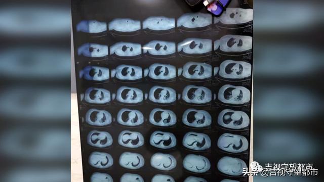 10岁男孩放学路上遭遇车祸,身体多处骨折、命悬一线
