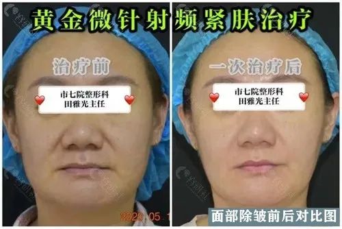 沈阳市第七人民医院激光美容中心田雅光黄金微针治疗前后对比图
