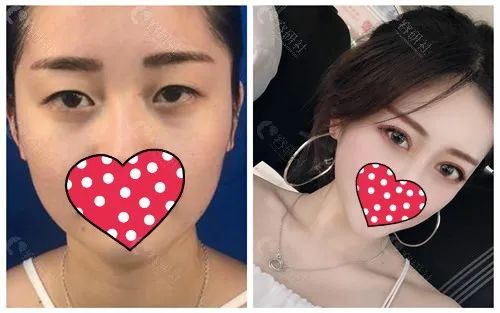上海华美双眼皮手术对比照